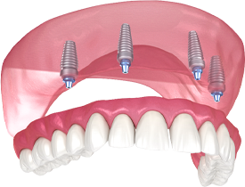 Покрывной протез на 4-х имплантах